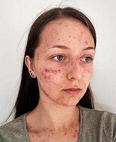 Betroffene von Skin-Picking verspüren einen unwiderstehlichen Drang. Foto: privat