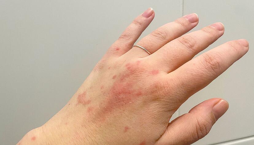 Ein Ausschlag auf der Hand - und meist nicht nur dort: Ein Nesselsucht-Schub verursacht juckende Quaddeln und R&ouml;tungen.