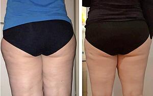 Vorher-Nachher-Effekt: Mittels der Liposuktion wurden bei Julia Uhde an den Beinen rund elf Liter krankhaftes Lip&ouml;dem-Fett abgesaugt. Foto: privat