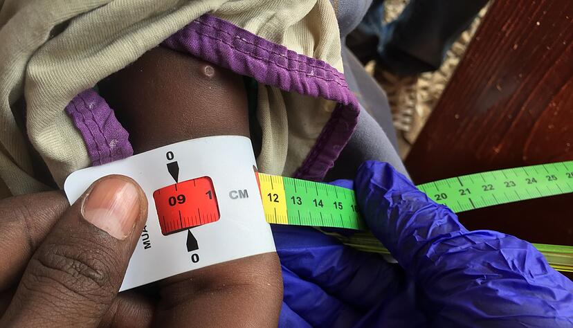 Ein Arzt misst im Sudan den Armumfang eines schwer unterern&auml;hrten Babys (Archivbild)