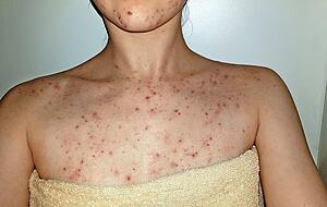 Das Krankheitsbild ist in Deutschland noch nicht gut erforscht. Mit ihrem Blog will Donat darüber aufklären. Auch auf Instagram ist sie aktiv. Fotos: privat