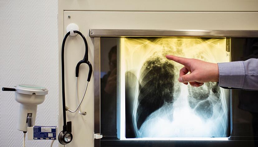 Tuberkulose-Erkrankungen werden in Europa oft nicht erkannt. (Illustration)