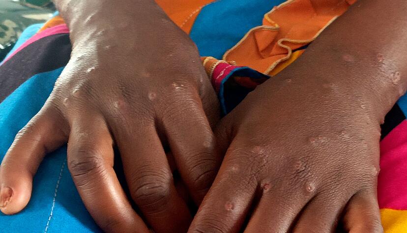 Mpox ist vor allem f&uuml;r kleine Kinder und immungeschw&auml;chte Menschen gef&auml;hrlich (Archivbild)