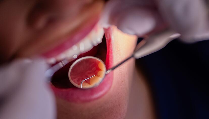 Loch im Zahn muss gef&uuml;llt werden? Auch k&uuml;nftig gibt es eine zuzahlungsfreie Variante