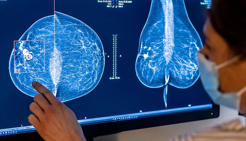 Für Frauen gibt es eine spezielle Untersuchung, um Krebs früh zu entdecken: die Mammografie. (Archivbild)