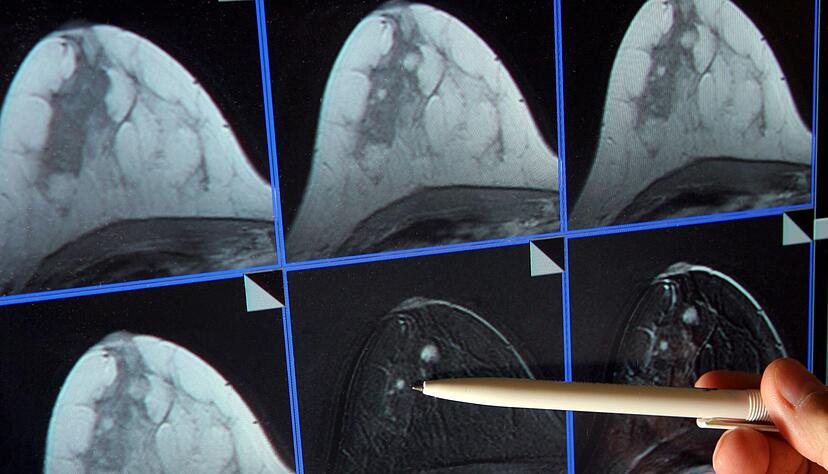 Im Zuge des Mammographie-Screening-Programms können Frauen alle zwei Jahre eine Röntgen-Untersuchung der Brust zur Früherkennung in Anspruch nehmen. (Archivbild) Im Zuge des Mammographie-Screening-Programms können Frauen alle zwei Jahre eine Röntgen-Untersuchung der Brust zur Früherkennung in Anspruch nehmen. (Archivbild)