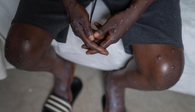 In Afrika fehlt Mpox-Impfstoff. (Archivbild)