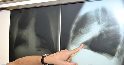 Das Risiko, in Deutschland an Krebs zu sterben, sinkt laut Forschern. Sorge bereitet den Medizinern allerdings die steigende Zahl an Lungenkrebs-Todesfällen bei Frauen.