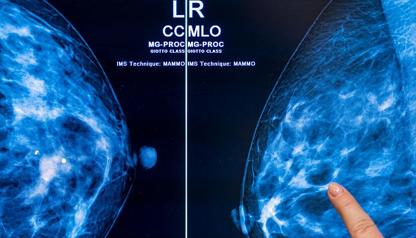 Brustkrebs stellt mit etwa 75.000 Neuerkrankungen jährlich die häufigste Krebserkrankung bei Frauen in Deutschland dar. (Archivbild) Brustkrebs stellt mit etwa 75.000 Neuerkrankungen jährlich die häufigste Krebserkrankung bei Frauen in Deutschland dar. (Archivbild)