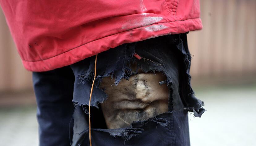 Hohe Verletzungsgefahr, sollten sie z&uuml;nden: B&ouml;ller und Co. geh&ouml;ren nicht in Hosen oder Jackentaschen.