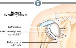 Bei einer inversen Prothese wird die Anatomie der Schulter komplett umgebaut.