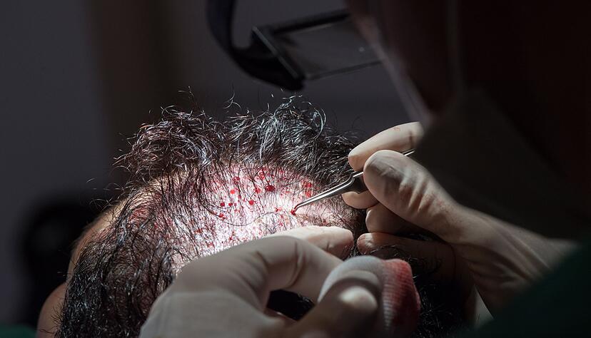 Unter bestimmten Voraussetzungen können die Kosten einer Haartransplantation steuerlich geltend gemacht werden. Unter bestimmten Voraussetzungen können die Kosten einer Haartransplantation steuerlich geltend gemacht werden.