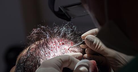 Unter bestimmten Voraussetzungen können die Kosten einer Haartransplantation steuerlich geltend gemacht werden.