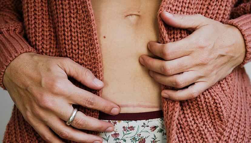 Sanfte Massagen und wenig Spannung: Das tut frischen Narben gut.