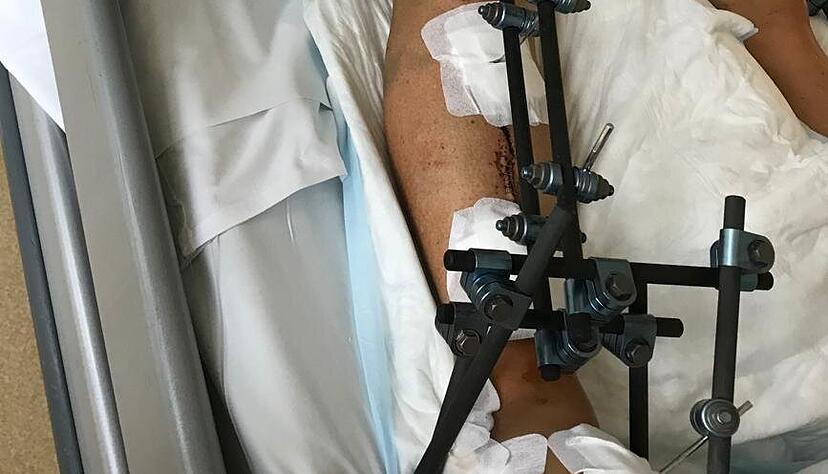 Das Bein steckt in einem Fixateur. Lange Schrauben stecken in den Knochenfragmenten. Das Bein steckt in einem Fixateur. Lange Schrauben stecken in den Knochenfragmenten.