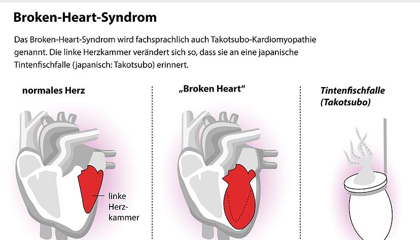 Das Broken-Heart-Syndrom erinnert an einen Herzinfarkt. Tats&auml;chlich ver&auml;ndert sich dabei aber vor allem die linke Herzkammer.