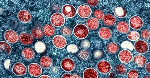 Beim Menschen wurden Mpox erstmals 1970 in der Demokratischen Republik Kongo identifiziert (Symbolbild).