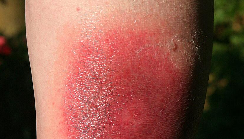 Klares Warnzeichen f&uuml;r Borreliose:&nbsp;Die sogenannte Wanderr&ouml;te kann Tage oder Wochen nach einem Zeckenstich auftreten.