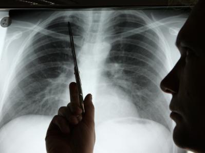 Das R&ouml;ntgenbild der Medizinischen Hochschule Hannover zeigt eine vom Krebs befallene Lunge (Archivbild).