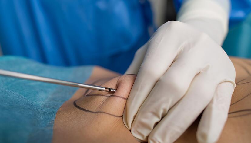 Unter bestimmten Voraussetzungen tr&auml;gt die gesetzliche Krankenversicherung k&uuml;nftig die Kosten f&uuml;r eine Liposuktion.