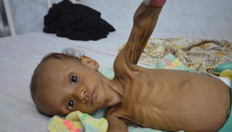 Im Jemen sind nach Schätzungen von Hilfsorganisationen sieben Millionen Menschen vom Hungertod bedroht. Foto: Amal al-Yarisi Im Jemen sind nach Schätzungen von Hilfsorganisationen sieben Millionen Menschen vom Hungertod bedroht. Foto: Amal al-Yarisi