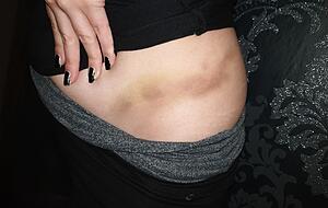 Nachdem Hannahs H&uuml;fte so blau war, hie&szlig; es erstmal Pause machen.