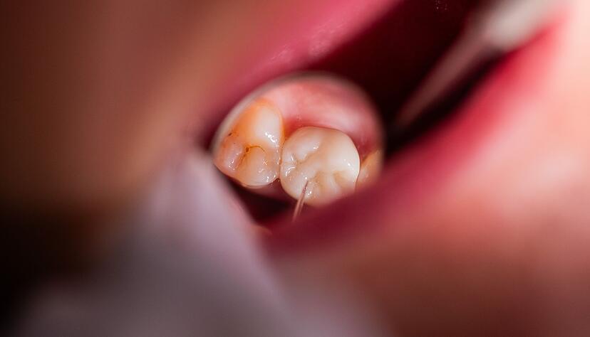 Zahnschmerzen vermiesen das Fest? Dann ist der zahn&auml;rztliche Notdienst die passende Anlaufstelle.