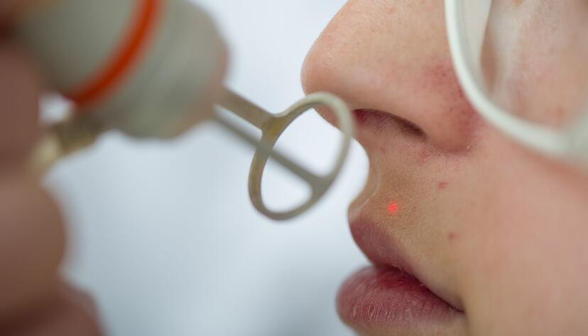 Wer sich dauerhaft von einzelnen Haaren verabschieden will, muss sie lasern lassen. Das geht aber nur bei dunklen Haaren.