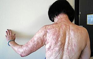 Kim Phuc leidet noch heute an den Folgen des Angriffs. Foto: Nick Ut Kim Phuc leidet noch heute an den Folgen des Angriffs. Foto: Nick Ut