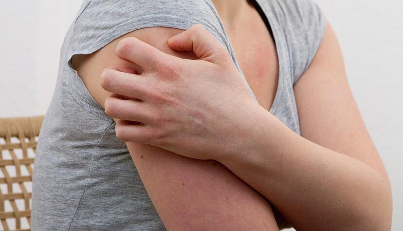 K&auml;lte, Hitze, hormonelle Ver&auml;nderungen, Infekte: Dem Ausl&ouml;ser einer Nesselsucht auf die Spur zu kommen, ist alles andere als einfach.