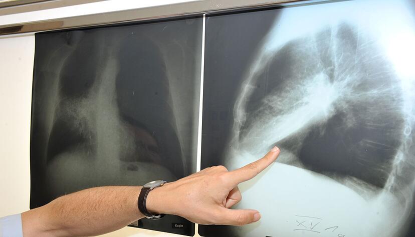 Ein Arzt zeigt auf ein Röntgenbild einer von Krebs befallenen Lunge. Ein Arzt zeigt auf ein Röntgenbild einer von Krebs befallenen Lunge.