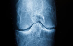Bei Arthrose ist Bewegung wichtig - auch wenn es weh tut. Bei Arthrose ist Bewegung wichtig - auch wenn es weh tut.