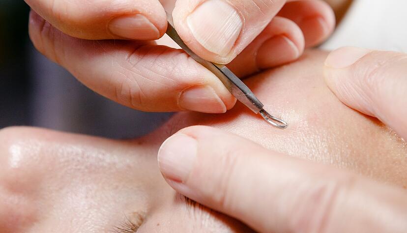 Hartn&auml;ckige Hautunreinheiten? Dann gilt: nicht darauf herumdr&uuml;cken, sondern Profis ranlassen.