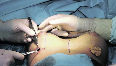 Zum Beispiel Brust-OP: Das Geschäft mit der Schönheit lohnt sich. Dass sich allerdings jeder Arzt "Schönheitschirurg" nennen darf, das würden die Fachärzte der plastischen Chirurgie gerne ändern. (Foto: Archiv) Zum Beispiel Brust-OP: Das Geschäft mit der Schönheit lohnt sich. Dass sich allerdings jeder Arzt "Schönheitschirurg" nennen darf, das würden die Fachärzte der plastischen Chirurgie gerne ändern. (Foto: Archiv)