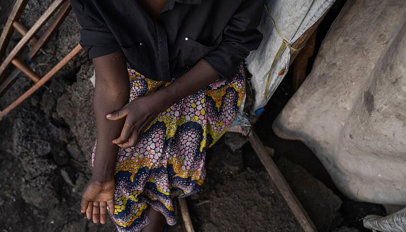 In Afrika gibt es schon 14.000 Mpox-Verdachtsf&auml;lle.